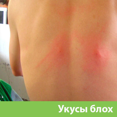 Укусы блох в Бузулуке