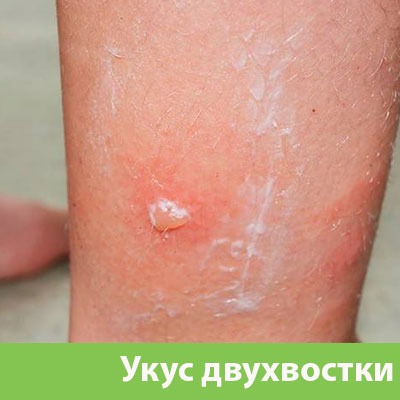 Укус двухвостки в Бузулуке