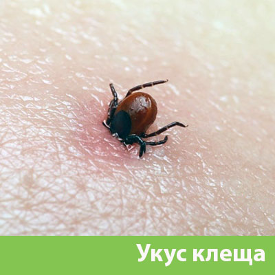 Укус клеща в Бузулуке