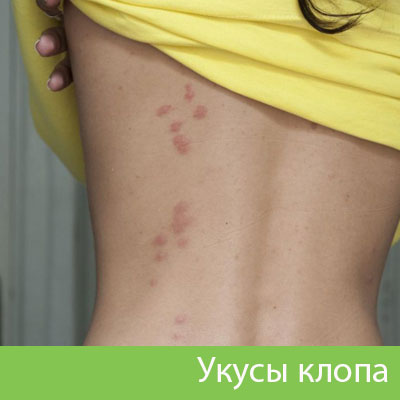 Профессиональное уничтожение клопов в Бузулуке